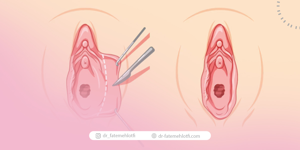چگونه از بروز عوارض لابیاپلاستی جلوگیری کنیم؟